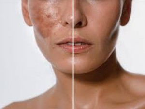 Chemical Peel Treatment